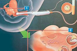 中山三院做三代试管成功率高吗？做三代试管生孩孩费用多少？